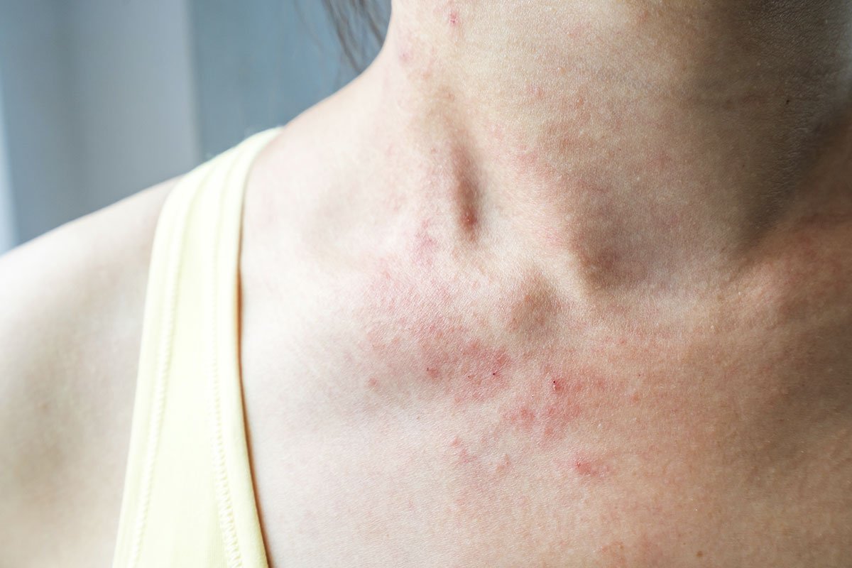 Dermatite de Contato | Dra. Brianna Nicoletti
