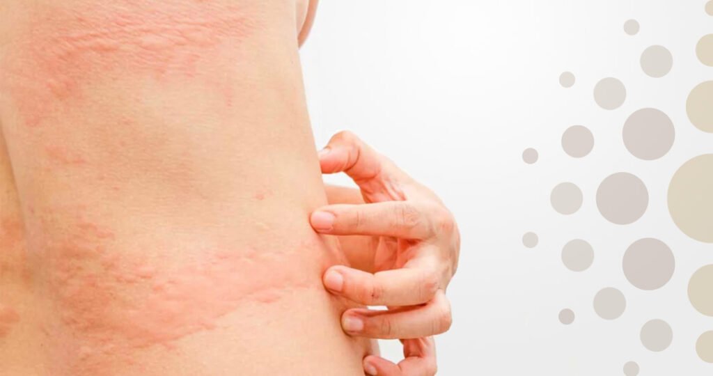 Alergia de pele e calor - Dra. Brianna Nicoletti