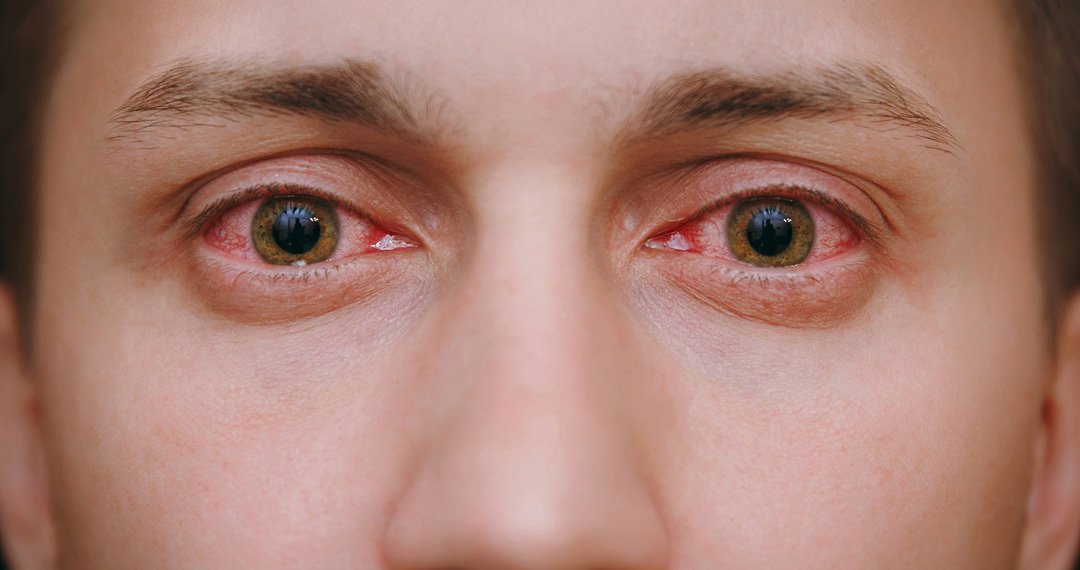 Conjuntivite alérgica: a irritação ocular é perigosa? | Dra. Brianna Nicoletti